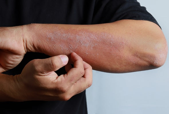 Guide to Infrared Light Therapy for Eczema